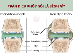 Cách chữa tràn dịch khớp gối bằng phương pháp Đông Y